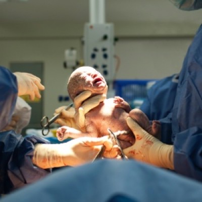 A taxa de lesões para os bebês em posição invertida que nasceram de cesárea é menor (Getty Images)