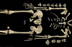 Esqueleto da mulher que teve leucemia (M. FRANCKEN/ UNIVERSIDADE DE TÜBINGEN)