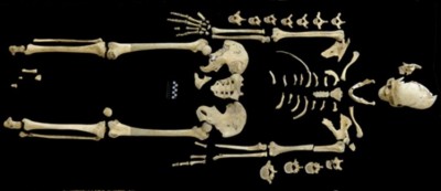 Esqueleto da mulher que teve leucemia (M. FRANCKEN/ UNIVERSIDADE DE TÜBINGEN)