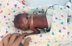 Bebê nasceu com 680 gramas durante cruzeiro em caribe (mily Morgan/AP)