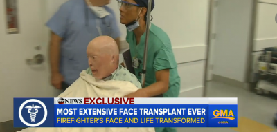 Como ficou a aparência do homem que fez um transplante facial?
