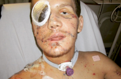 Veja o que aconteceu com o soldado que se jogou na frente de uma granada para salvar uma vida