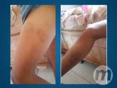 Criança de 9 anos é espancada com corrente de bicicleta depois de brigar com irmã