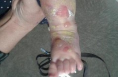 Bebê ficou com queimaduras no pé e em parte da perna. (Foto: Direto das ruas/Campo Grande News) ()